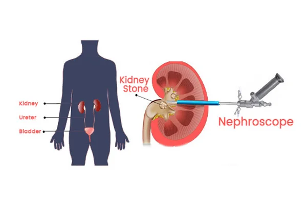 PCNL Surgery