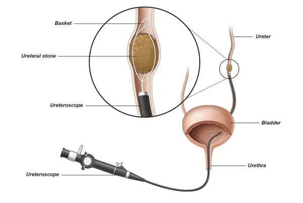 URS Surgery
