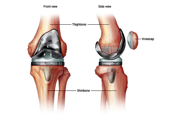 Total Knee Replacement Surgery