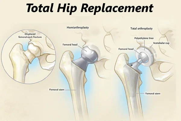 Total Hip Replacement Surgery