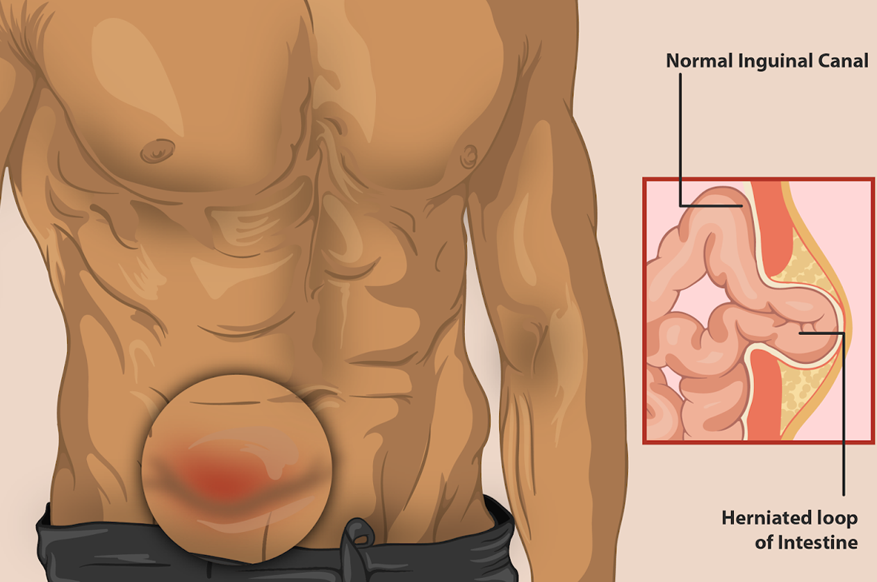 Hernioplasty Surgery