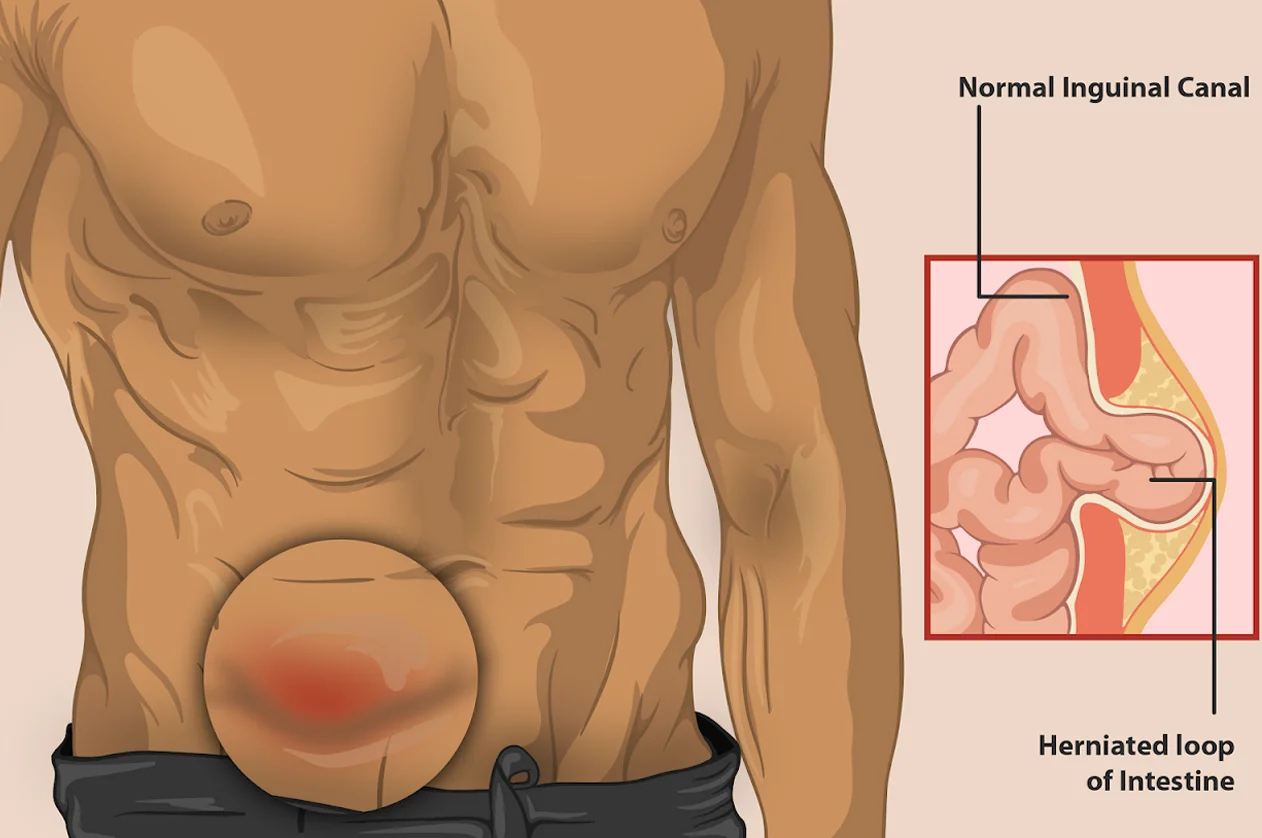 Hernioplasty Surgery