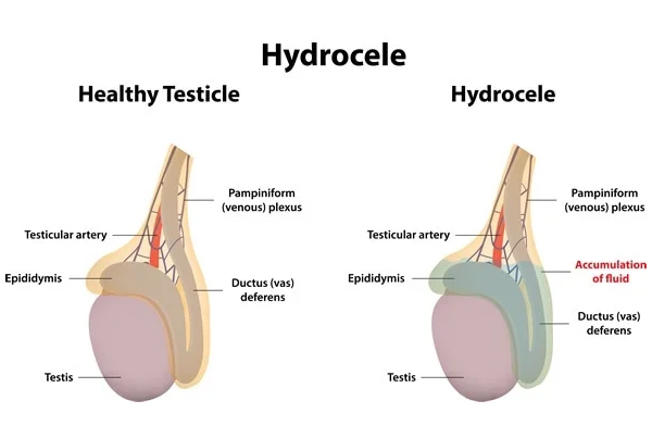 Hydrocele Surgery