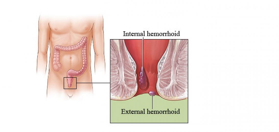 Hemorrhoidectomy Surgery