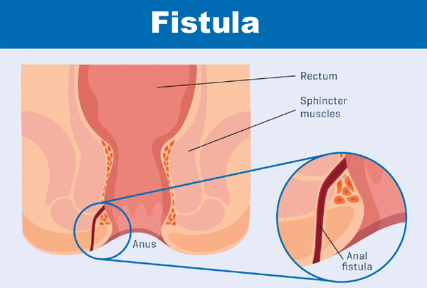 Fistula Surgery