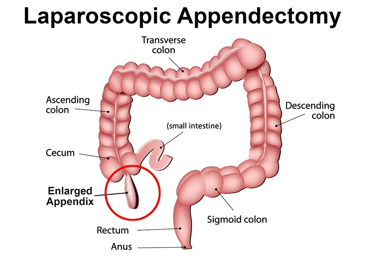 Appendectomy Surgery