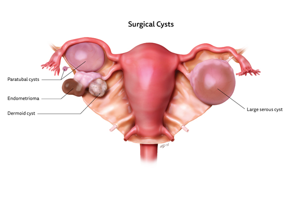 Cystectomy Surgery