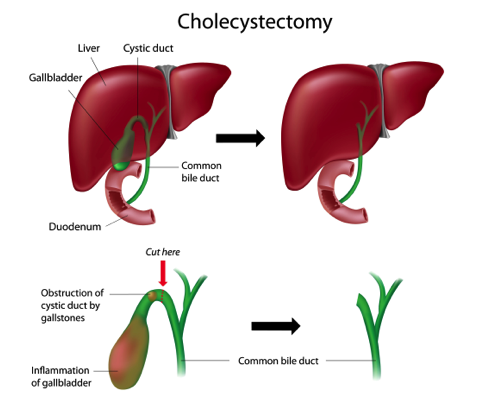 Cholecystectomy Surgery