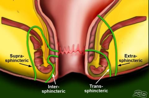 Fistula Surgery: Treatment & Recovery | Mark Hospital Noida